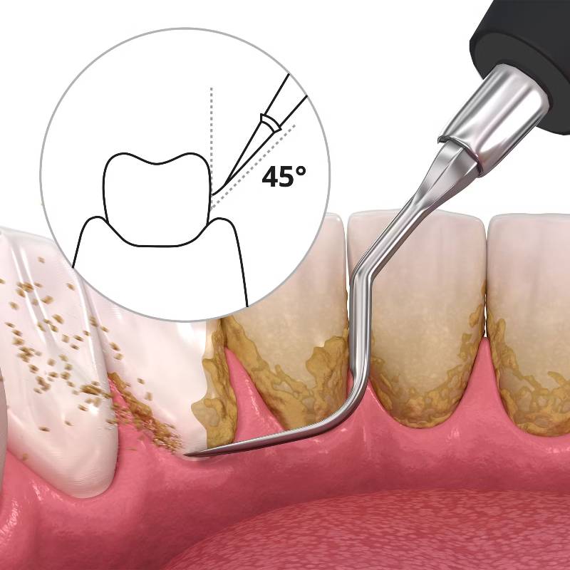 DEPLAQUED Sonic Tooth Cleaner