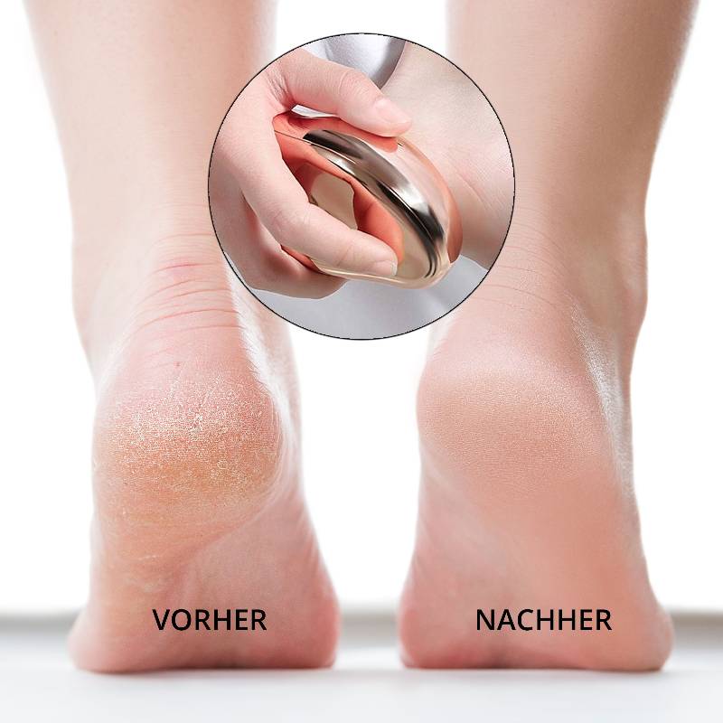 Callus Remover